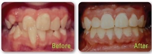 ฟันซ้อนเก ฟันล่างคร่อมฟันบน Crowding teeth, lower teeth covering upper teeth