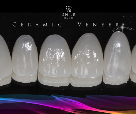 Veneer pic 4-3