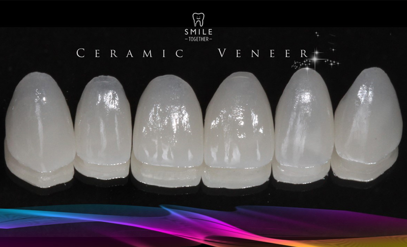 Veneer pic